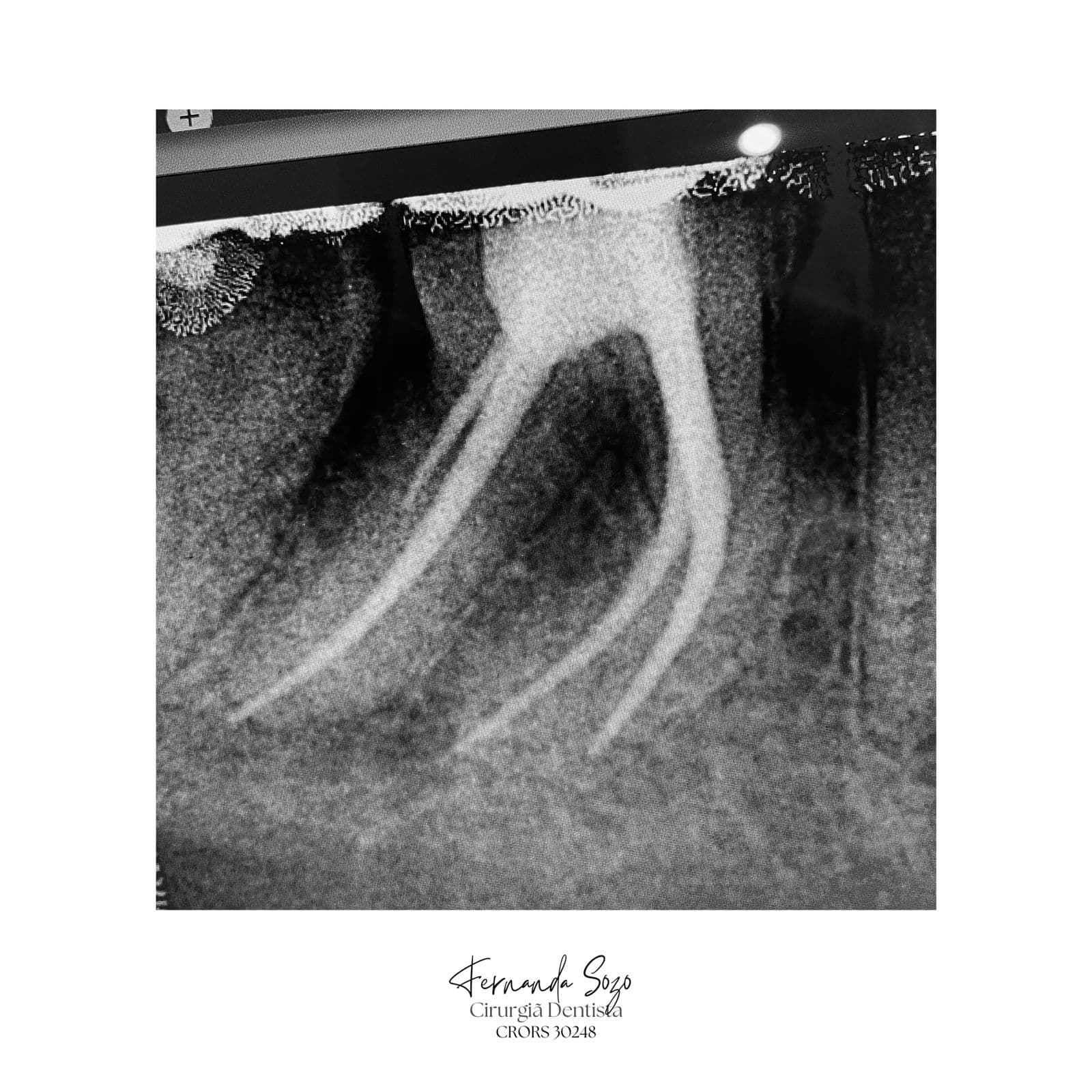 Endodontia de incisivo lateral com reabsorção interna