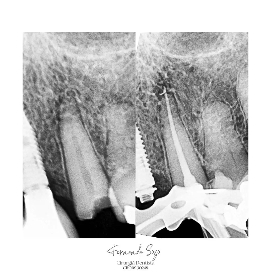 Retratamento de canal em pré-molar superior com curva acentuada