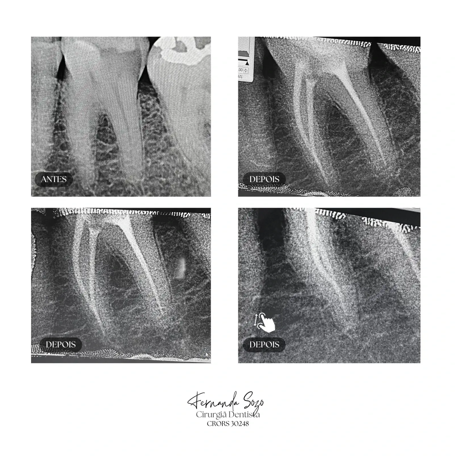 Endodontia de molar superior com quatro canais