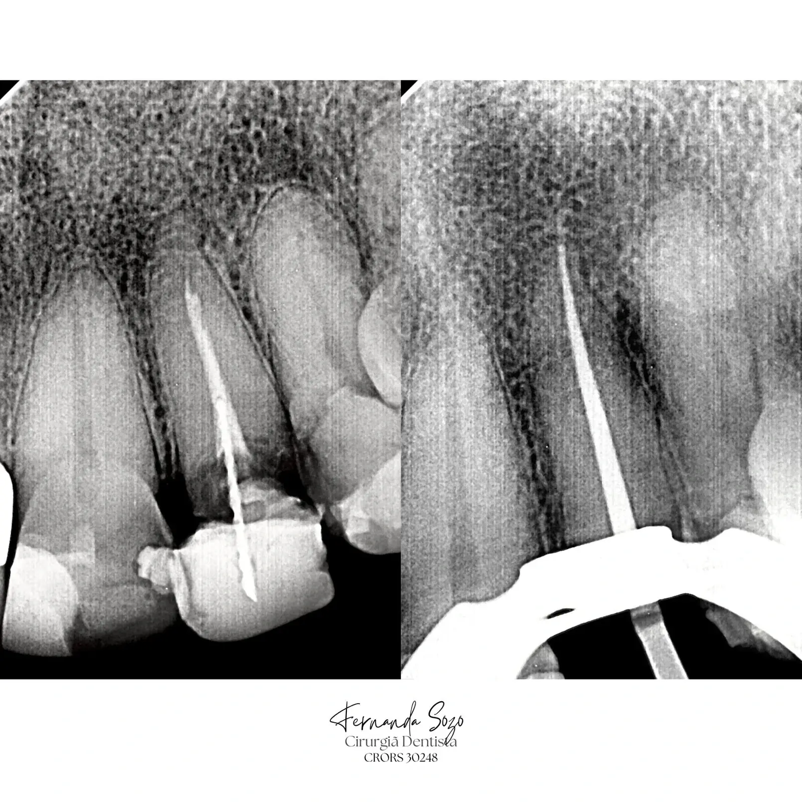 Retratamento endodôntico com remoção de material obturador antigo