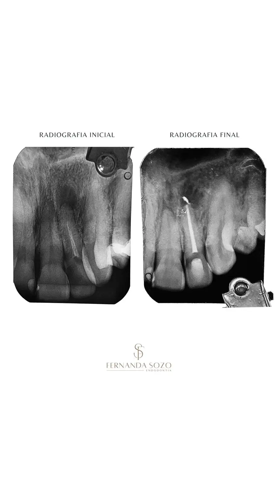 Tratamento de canal em molar com anatomia complexa